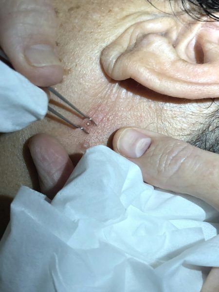 Esthetician removing an ingrown hair.