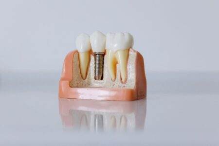 Implant cérébral : StairMed vise une pose en dix minutes par une veine du cou Detailed dental implant model showcasing teeth structure for educational purposes.