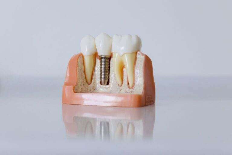 Implant cérébral : StairMed vise une pose en dix minutes par une veine du cou Detailed dental implant model showcasing teeth structure for educational purposes.