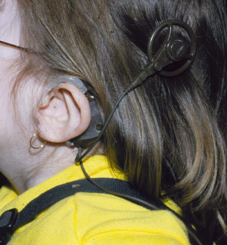 Child wearing early Cochlear Limited body-worn processor