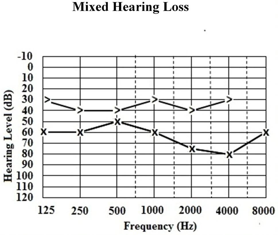 An audiogram with mixed hearing loss for the left ear